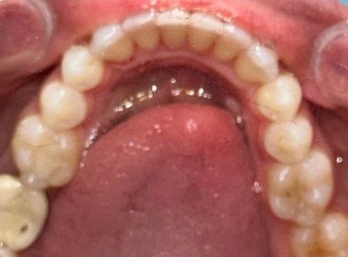 After — Case 1: Invisalign Misalignment Correction