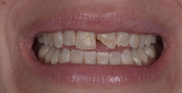 Before — Case 2: Dental Crown Restoration