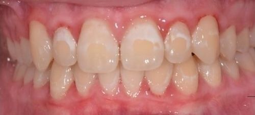 Before — Case 3: Teeth Whitening