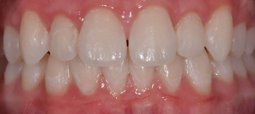 After — Case 3: Teeth Whitening