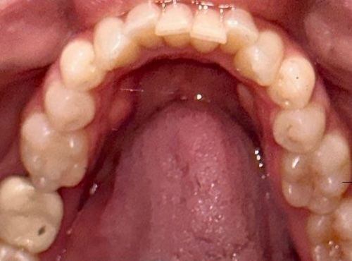 Before — Case 1: Invisalign Misalignment Correction
