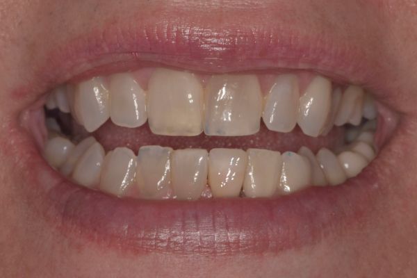 After — Case 2: Dental Crown Restoration